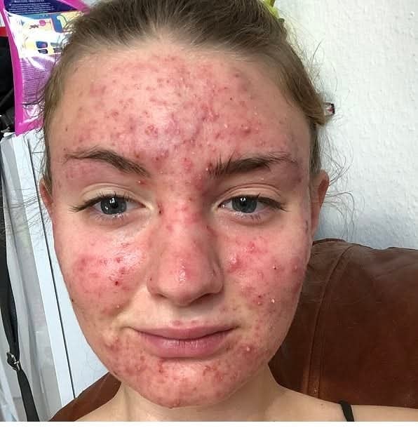 HT9. Her body was itching, thought it was an allergy but they diagnosed ca…