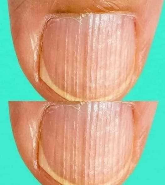 If you have these lines on your nails it’s a clear sign…See more  